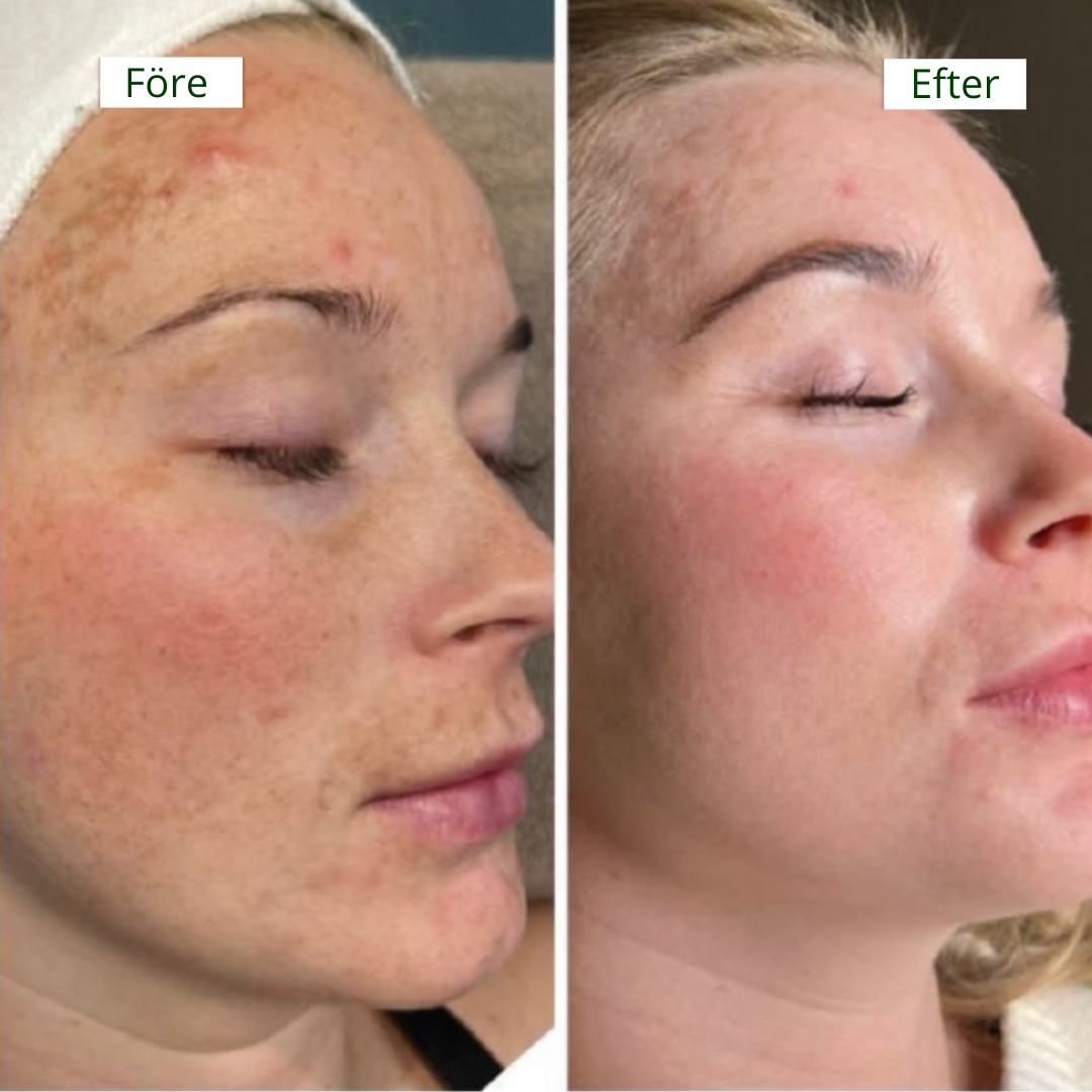 ClearBeauty Pads - Jämnare hy & återfuktning